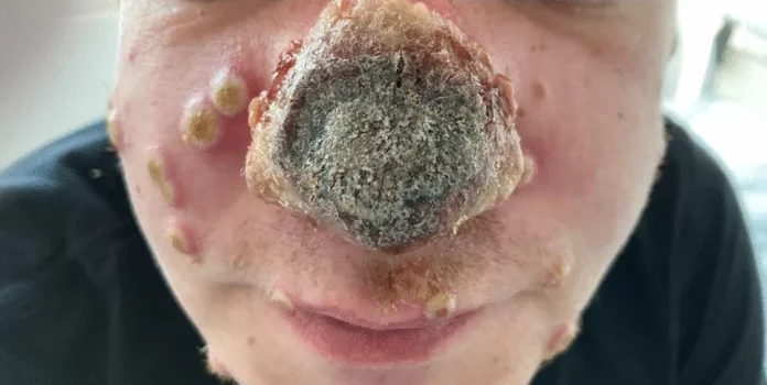 nasal necrosis