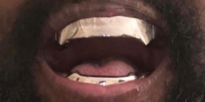 Kanye West's titanium teeth