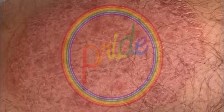 ‘Pride’ Month Features U.S. Debut of New Sexually Transmitted Ringworm