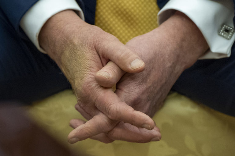 BREAKING: President Trump Diagnosed w/ ‘Chronic Venous Insufficiency’